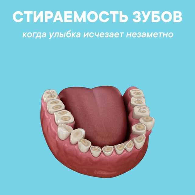 Стираемость зубов: незаметная проблема с серьёзными последствиями Стираемость зубов: незаметная проблема с серьёзными последствиями